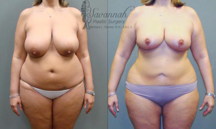 Before & After Breast Reduction Case 50 View 1 View in Savannah, Georgia