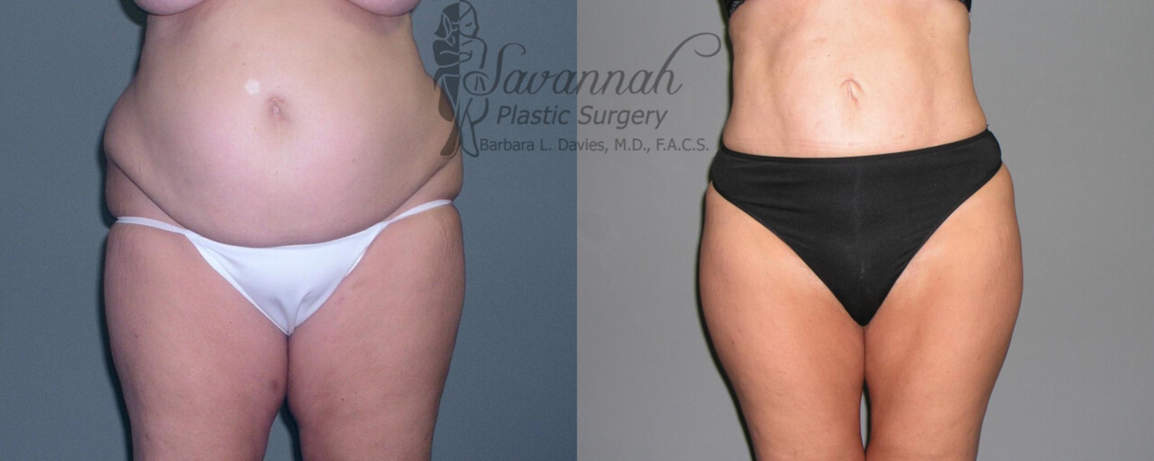 Before & After Liposuction Case 51 View 1 View in Savannah, Georgia