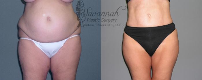 Before & After Liposuction Case 51 View 1 View in Savannah, Georgia