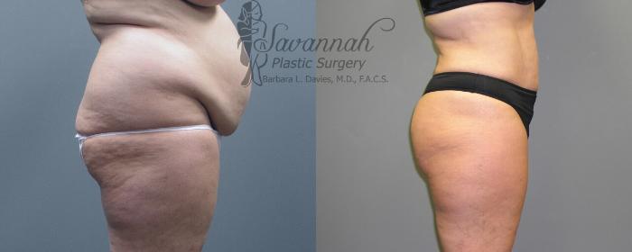 Before & After Liposuction Case 51 View 2 View in Savannah, Georgia
