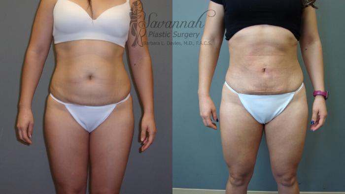 Before & After Liposuction Case 52 View 1 View in Savannah, Georgia