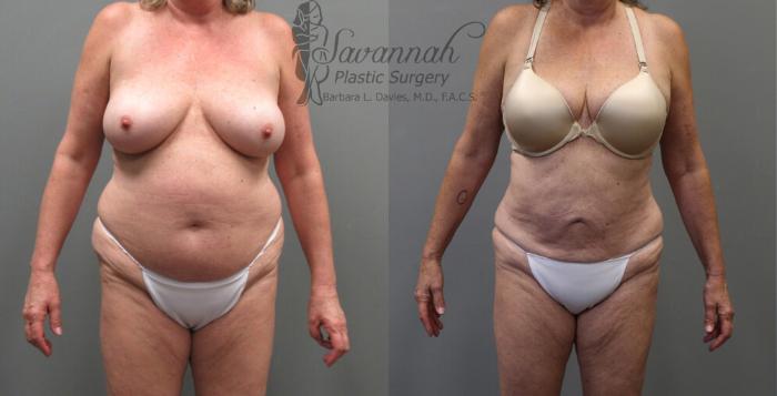 Before & After Liposuction Case 53 View 1 View in Savannah, Georgia