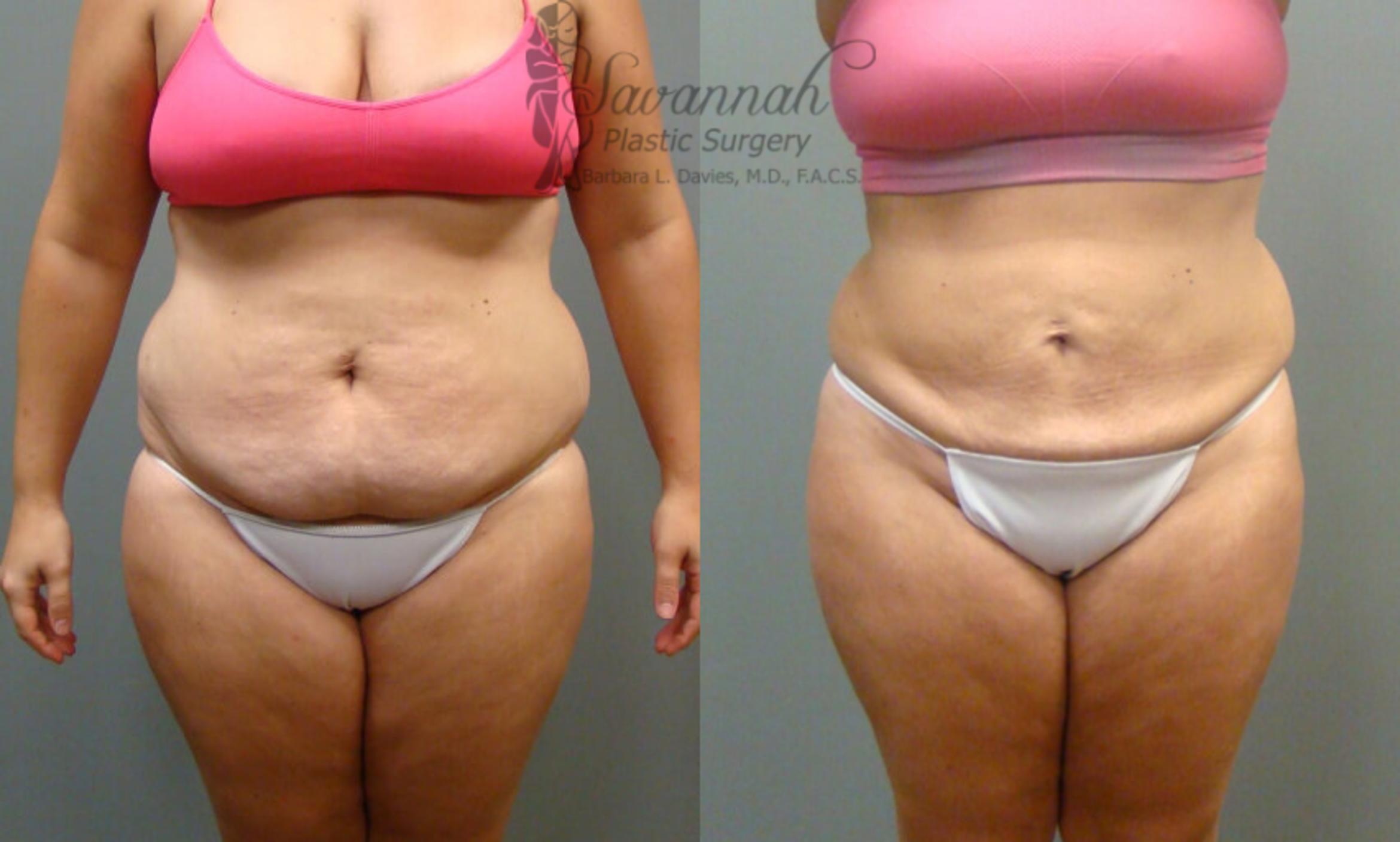 Before & After Liposuction Case 54 View 1 View in Savannah, Georgia