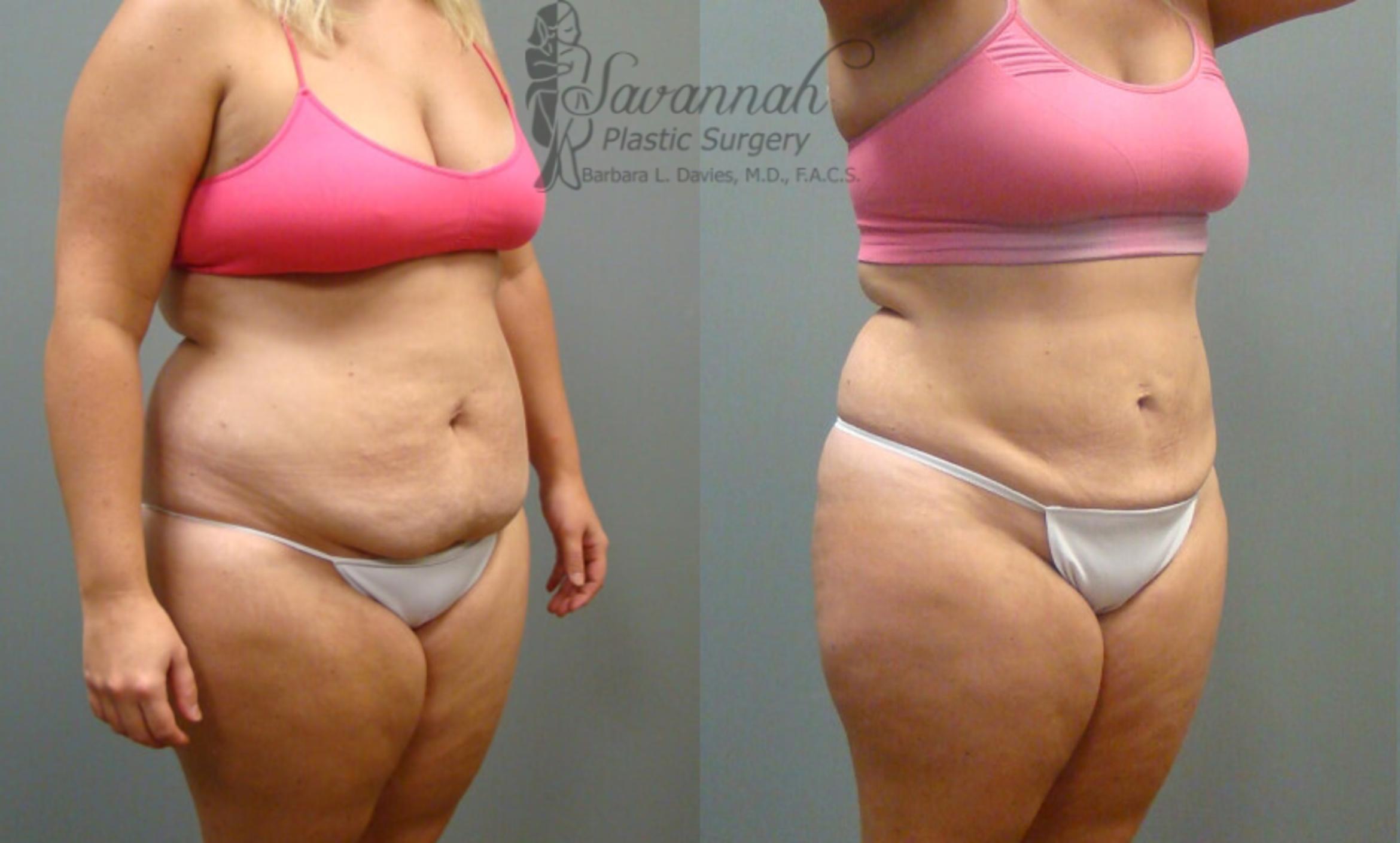 Before & After Liposuction Case 54 View 2 View in Savannah, Georgia