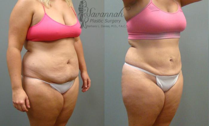 Before & After Liposuction Case 54 View 2 View in Savannah, Georgia