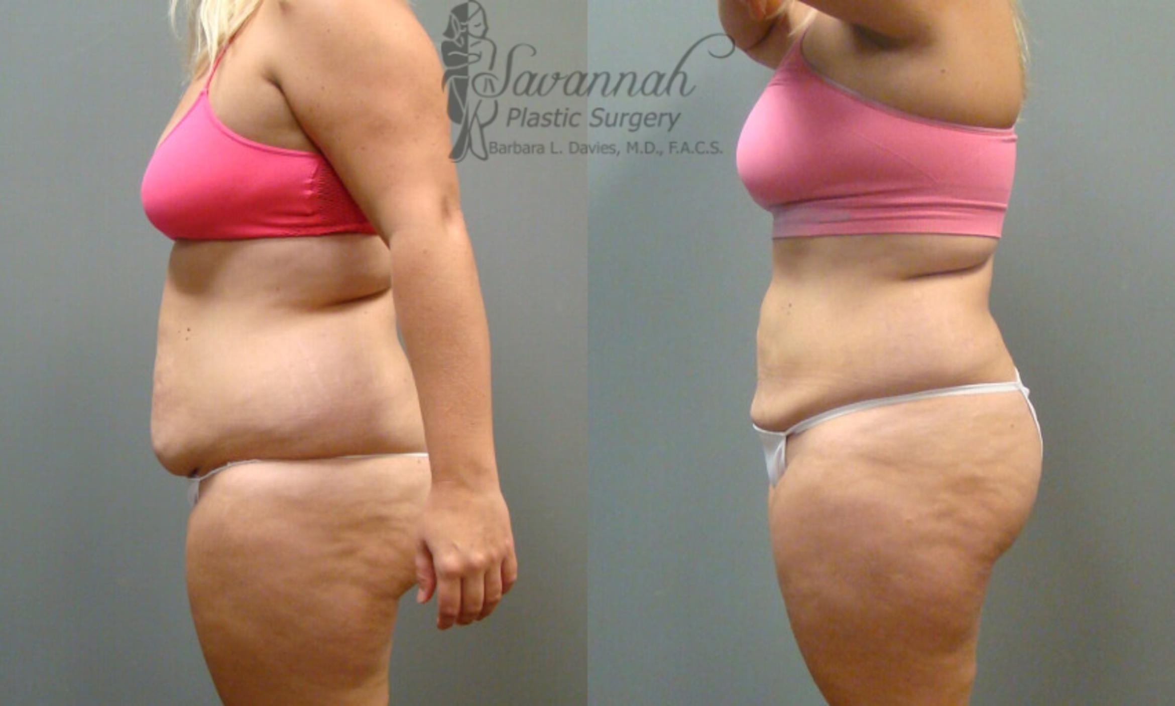 Before & After Liposuction Case 54 View 3 View in Savannah, Georgia