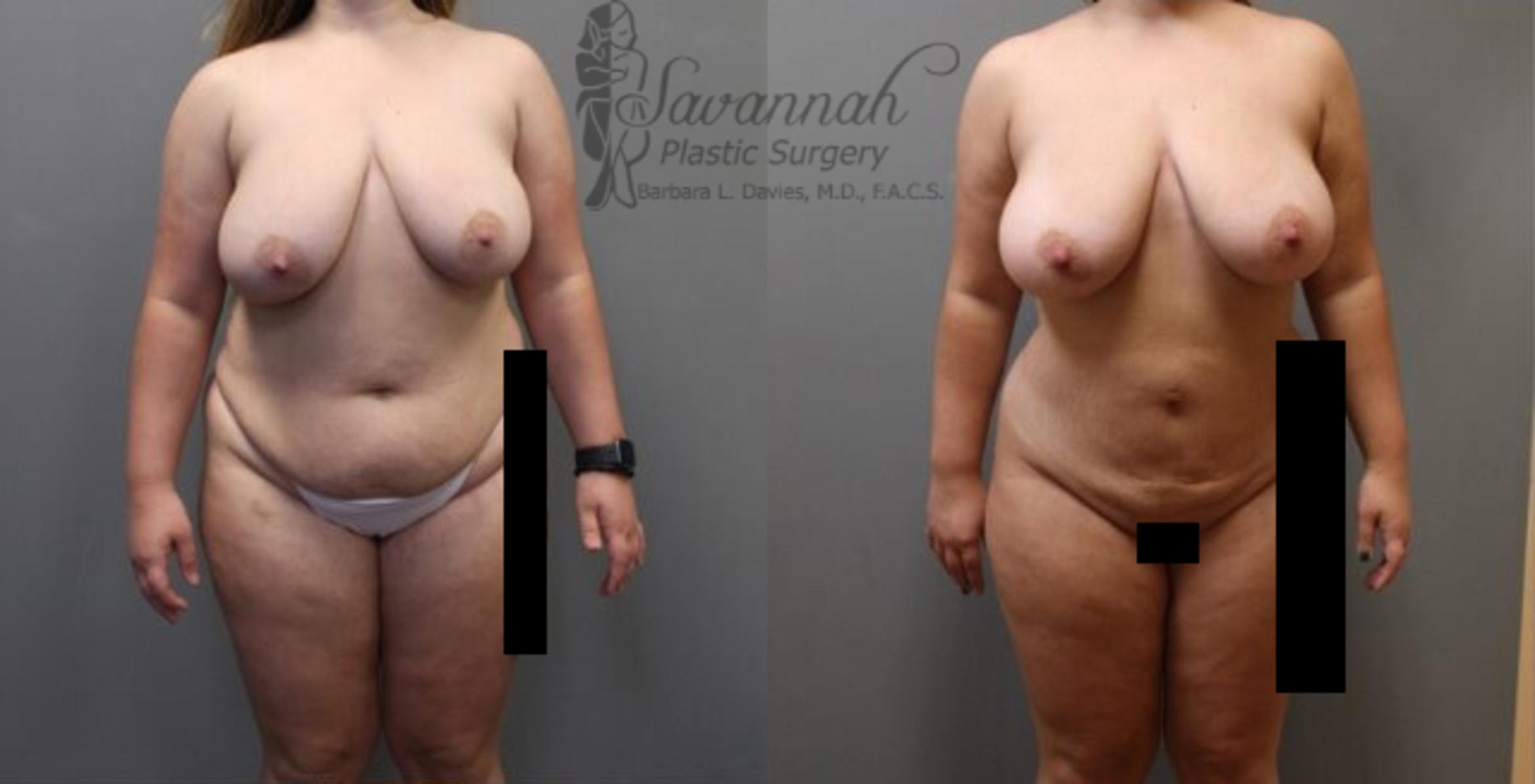 Before & After Liposuction Case 56 View 1 View in Savannah, Georgia