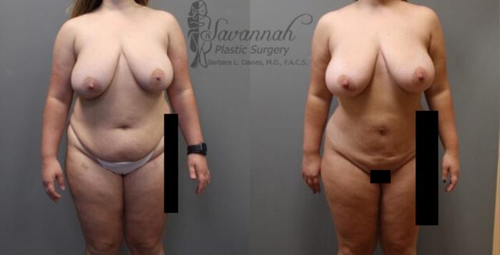 Before & After Liposuction Case 56 View 1 View in Savannah, Georgia