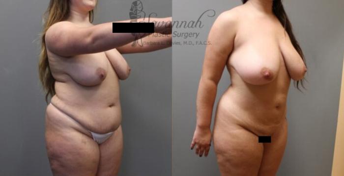 Before & After Liposuction Case 56 View 2 View in Savannah, Georgia