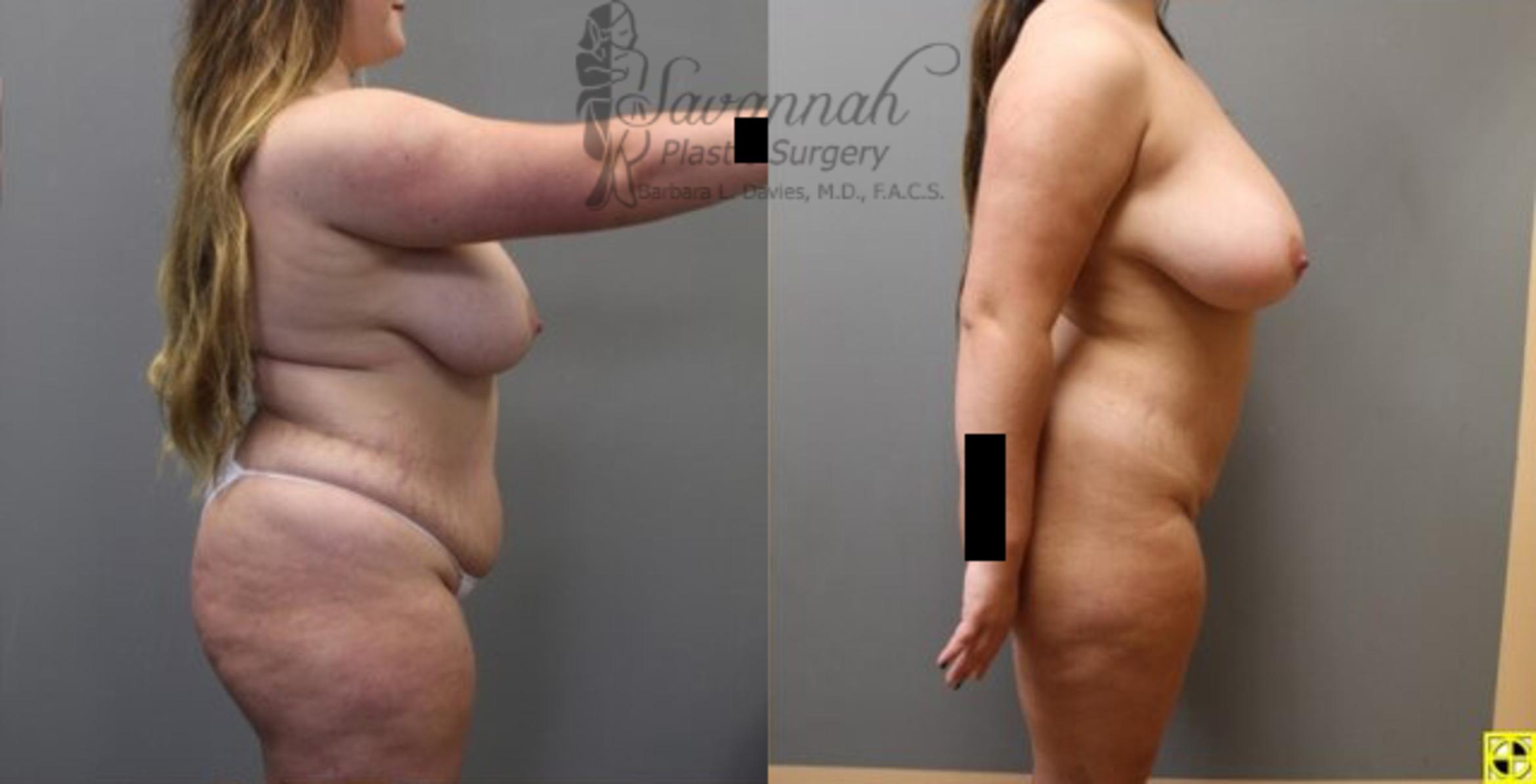 Before & After Liposuction Case 56 View 3 View in Savannah, Georgia