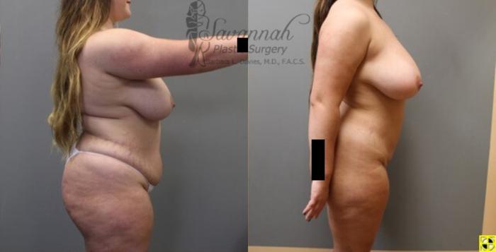 Before & After Liposuction Case 56 View 3 View in Savannah, Georgia