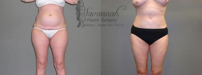 Before & After Liposuction Case 58 View 1 View in Savannah, Georgia