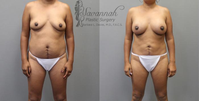 Before & After Liposuction Case 28 View 1 View in Savannah, Georgia