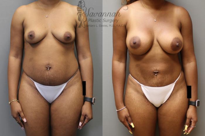 Before & After Liposuction Case 29 View 1 View in Savannah, Georgia