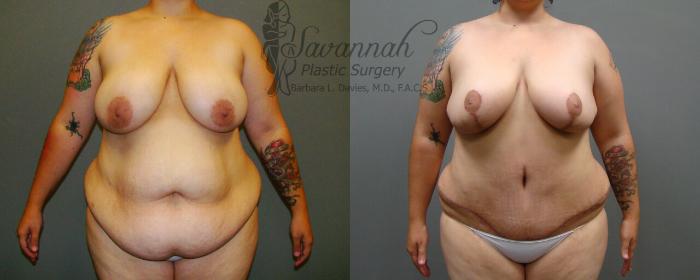 Before & After Breast Reduction Case 22 View 1 View in Savannah, Georgia