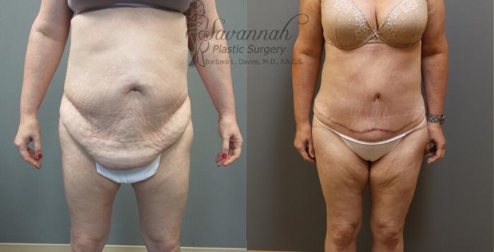 Before & After Tummy Tuck Case 31 View 1 View in Savannah, Georgia