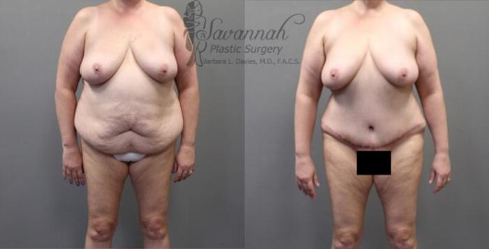 Before & After Tummy Tuck Case 32 View 1 View in Savannah, Georgia