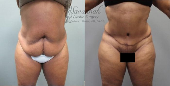 Before & After Tummy Tuck Case 33 View 1 View in Savannah, Georgia