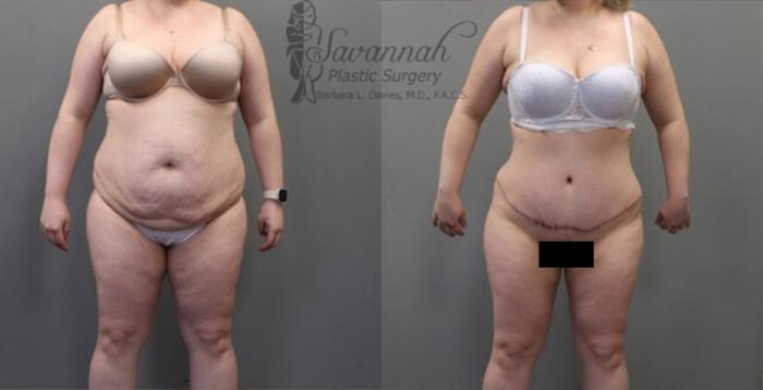 Before & After Tummy Tuck Case 34 View 1 View in Savannah, Georgia