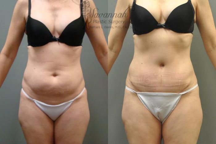 Before & After Tummy Tuck Case 36 View 1 View in Savannah, Georgia