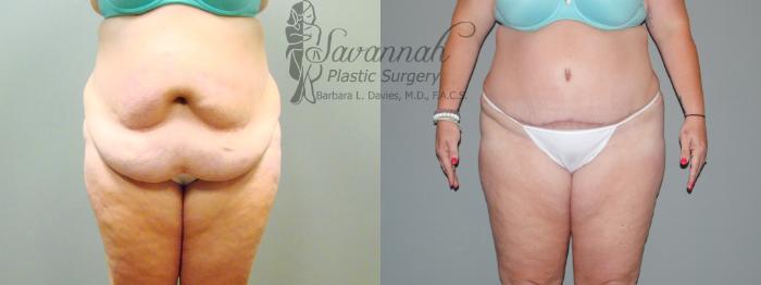 Before & After Tummy Tuck Case 37 View 1 View in Savannah, Georgia
