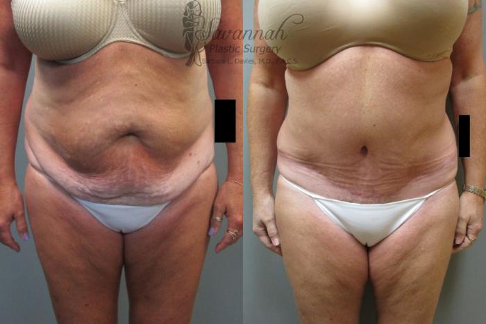 Before & After Tummy Tuck Case 38 View 1 View in Savannah, Georgia