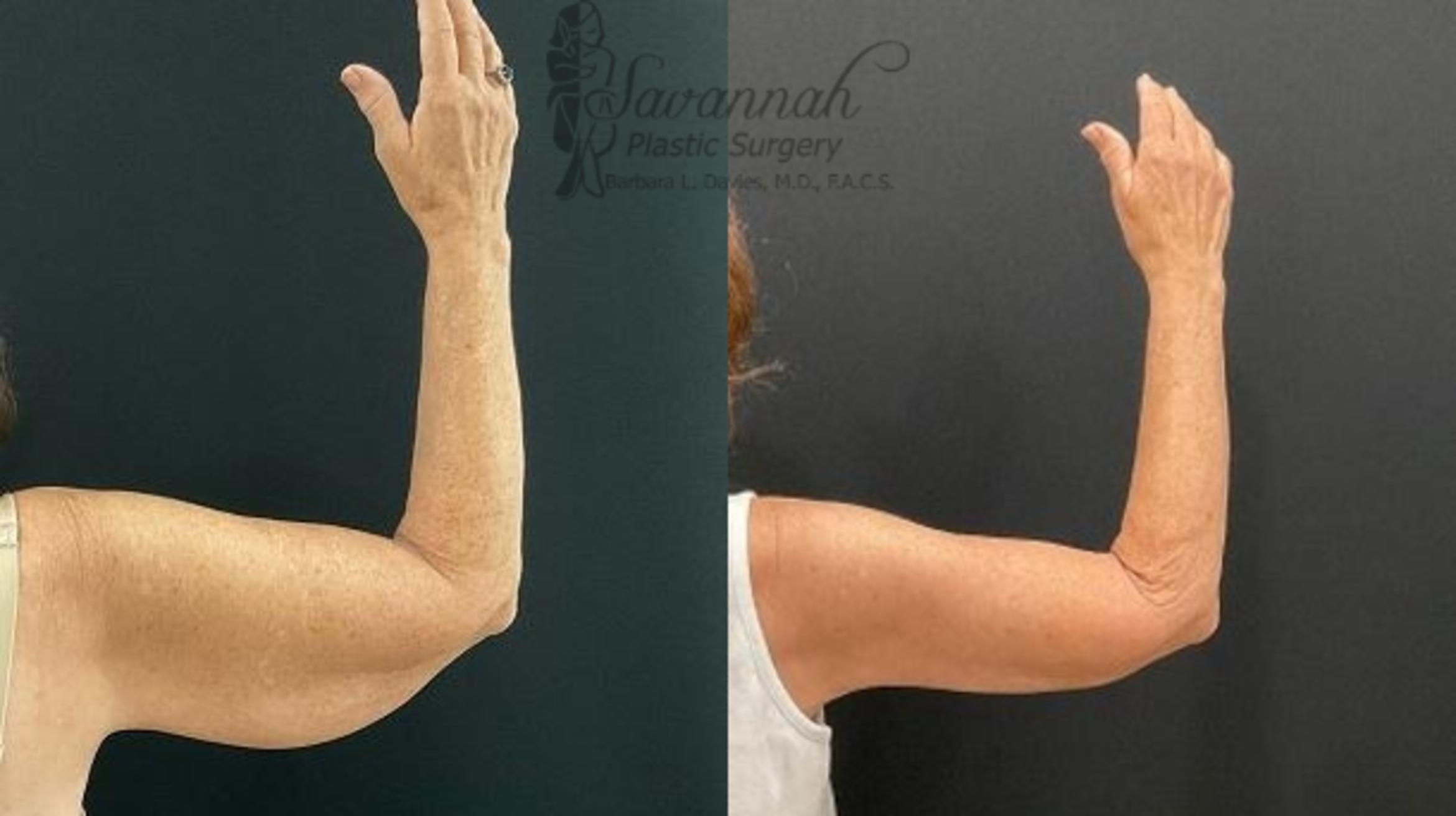 Before & After Arm Lift Case 101 Back View in Savannah, Georgia
