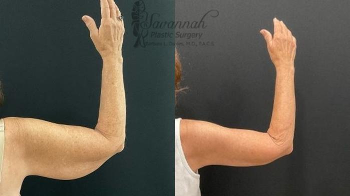 Before & After Arm Lift Case 101 Back View in Savannah, Georgia