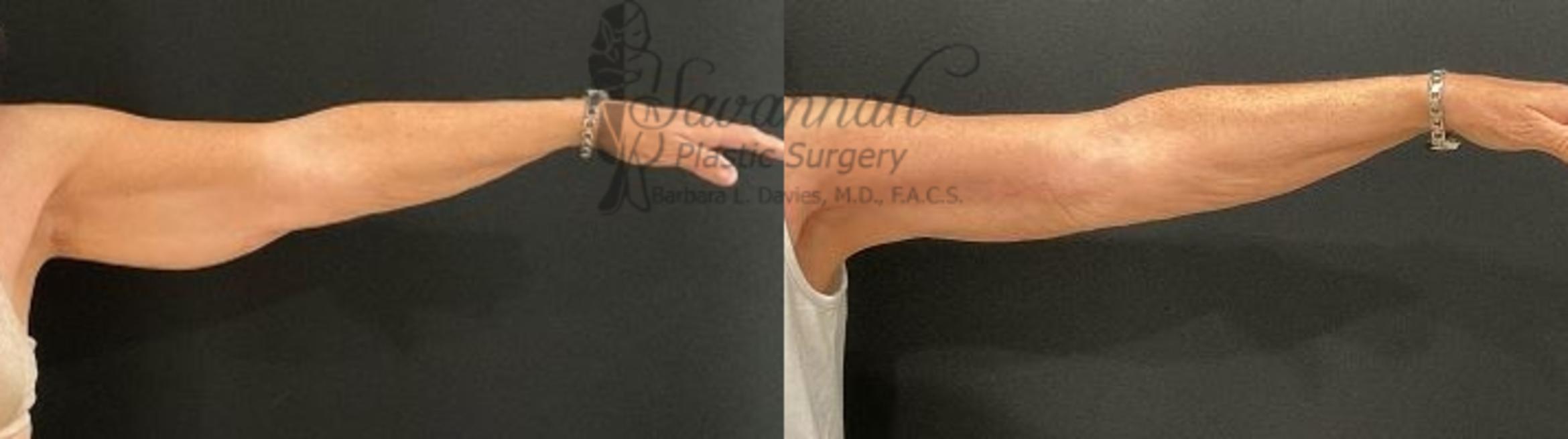 Before & After Arm Lift Case 101 Front View in Savannah, Georgia