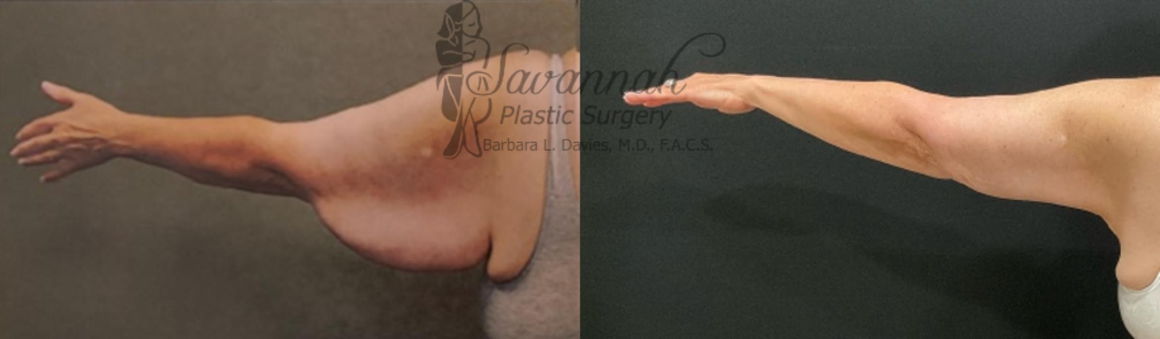 Before & After Arm Lift Case 85 Back View in Savannah, Georgia