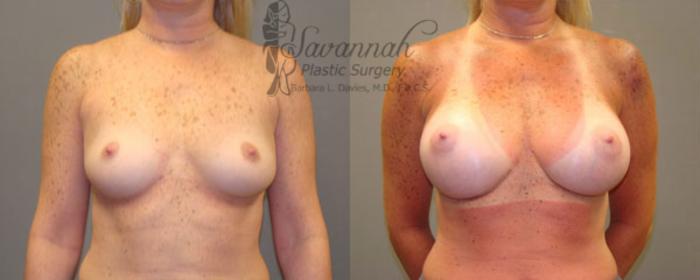Before & After Breast Augmentation Case 10 View 1 View in Savannah, Georgia