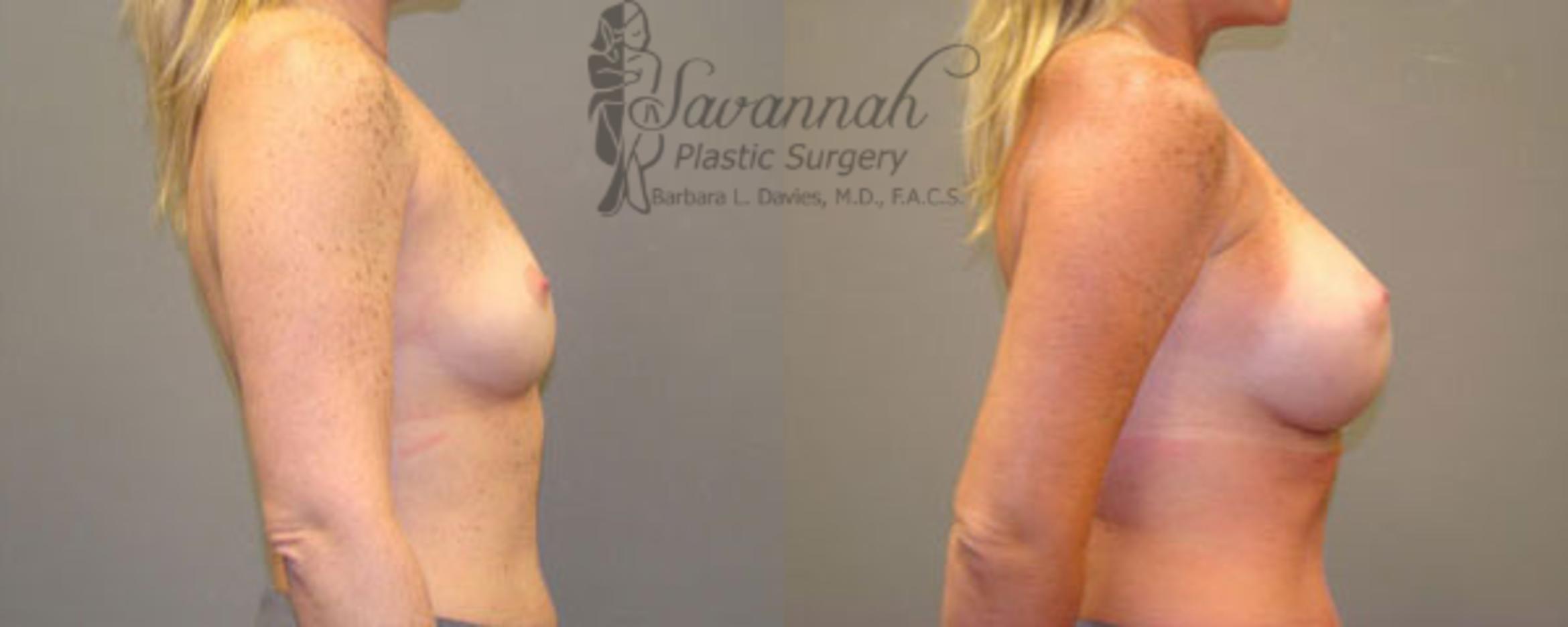 Before & After Breast Augmentation Case 10 View 2 View in Savannah, Georgia
