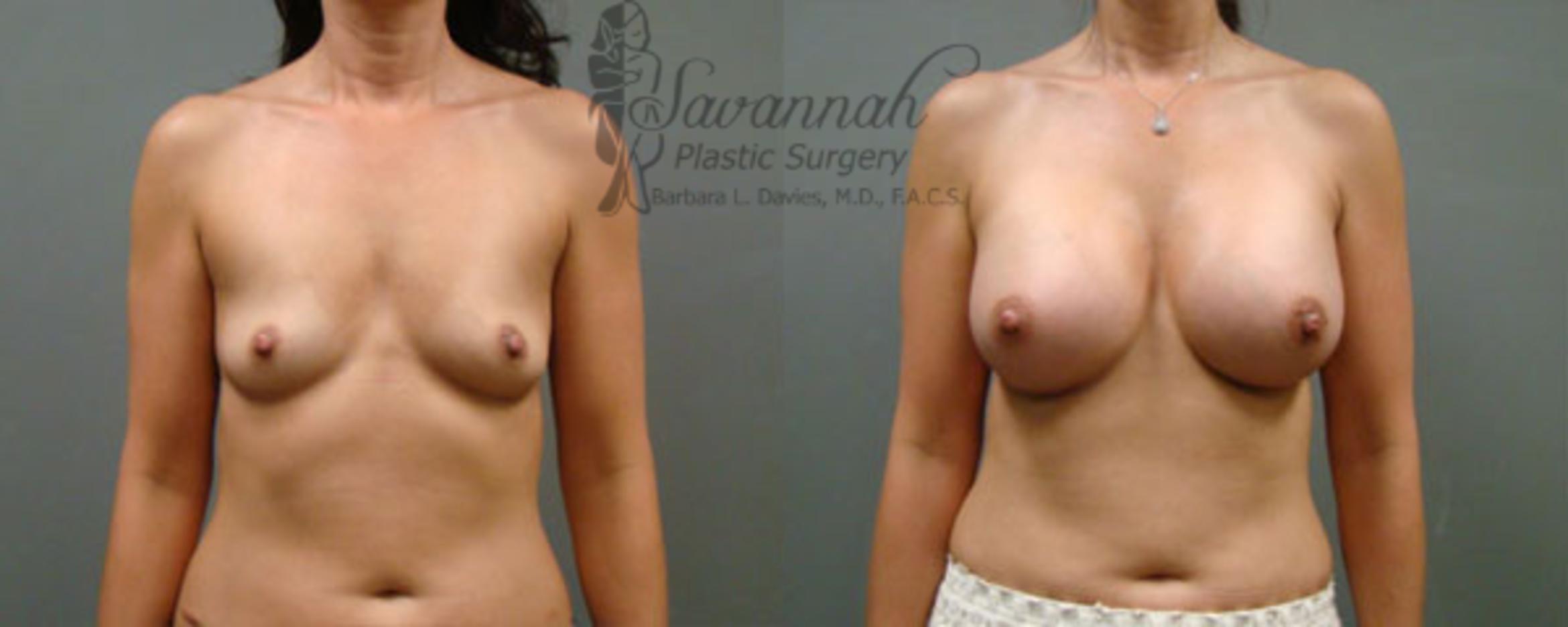 Before & After Breast Augmentation Case 11 View 1 View in Savannah, Georgia