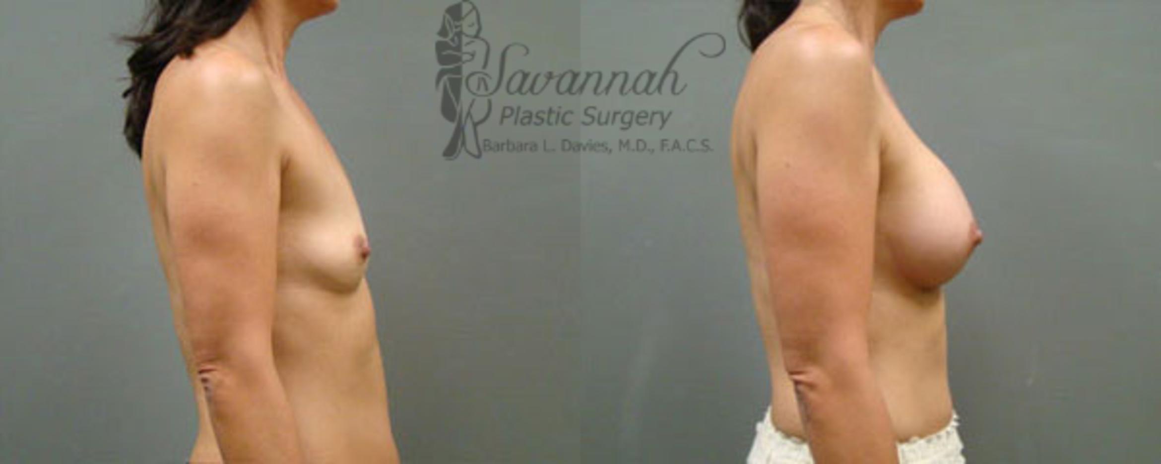 Before & After Breast Augmentation Case 11 View 2 View in Savannah, Georgia