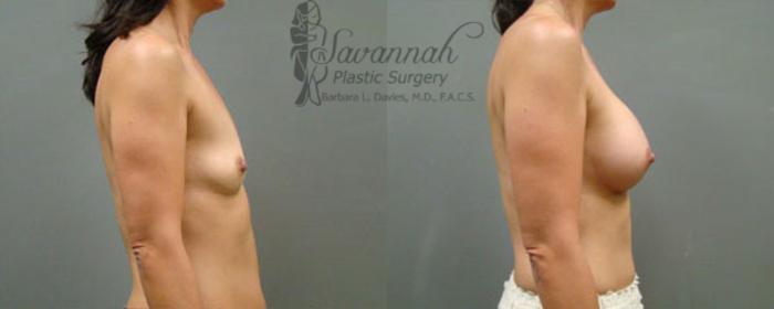 Before & After Breast Augmentation Case 11 View 2 View in Savannah, Georgia