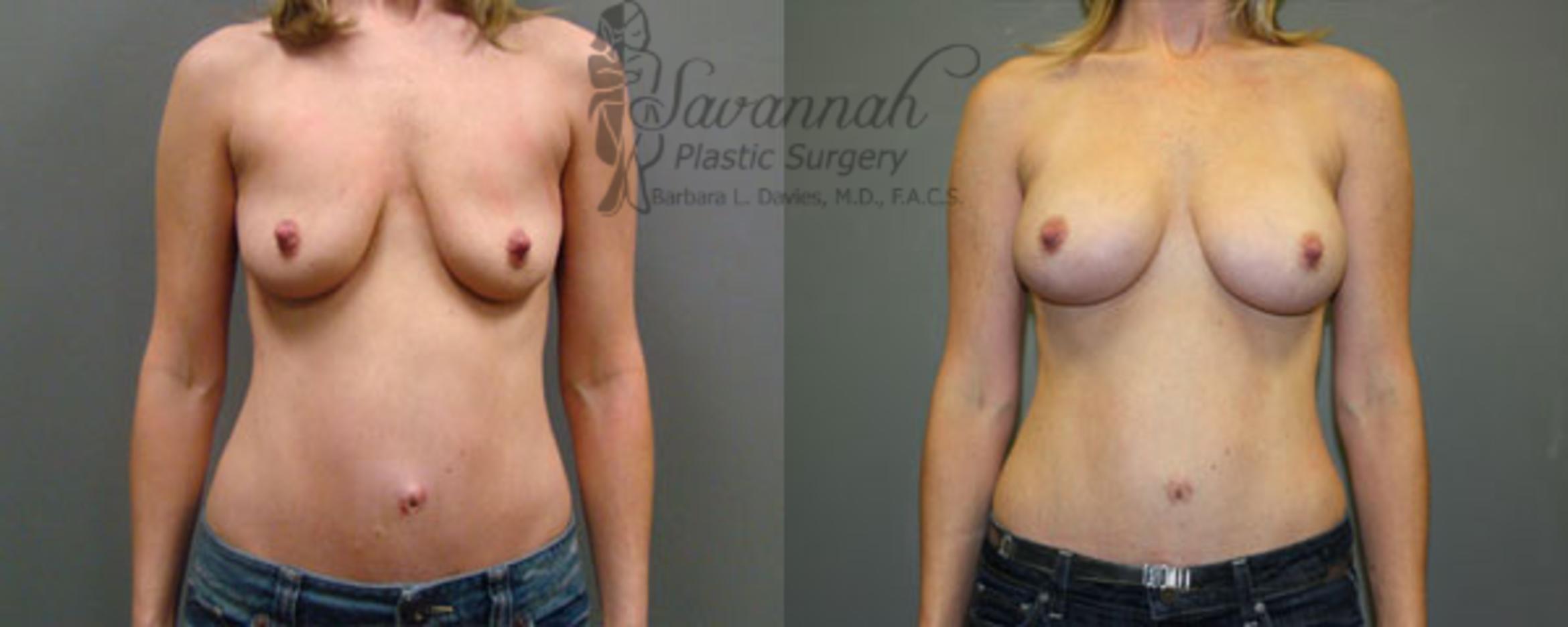 Before & After Breast Augmentation Case 12 View 1 View in Savannah, Georgia