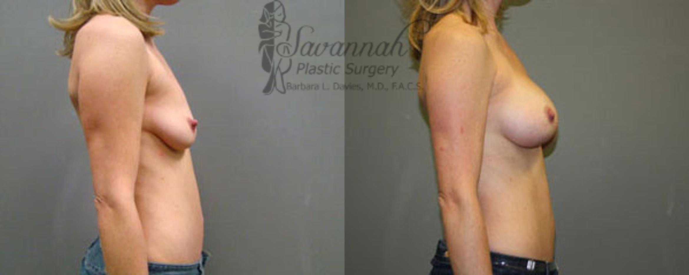 Before & After Breast Augmentation Case 12 View 2 View in Savannah, Georgia