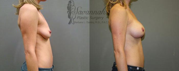 Before & After Breast Augmentation Case 12 View 2 View in Savannah, Georgia