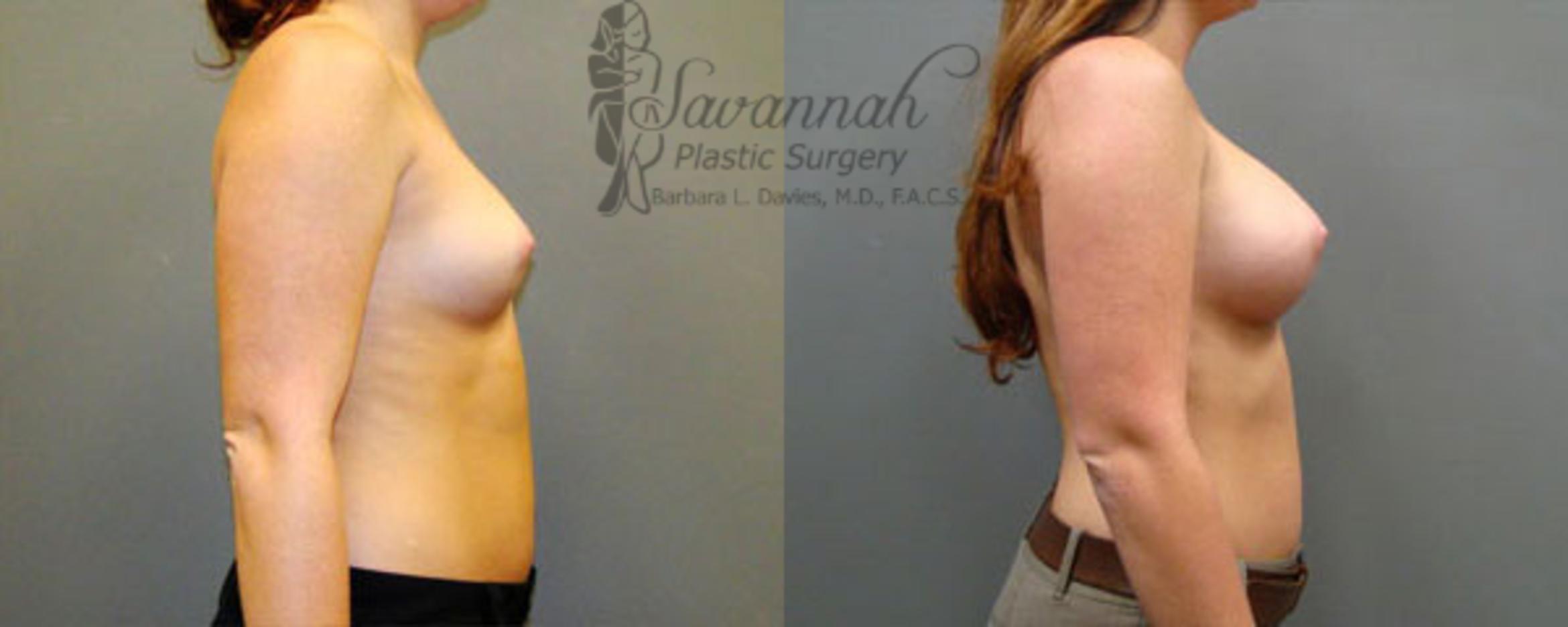 Before & After Breast Augmentation Case 15 View 2 View in Savannah, Georgia
