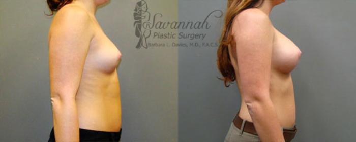 Before & After Breast Augmentation Case 15 View 2 View in Savannah, Georgia