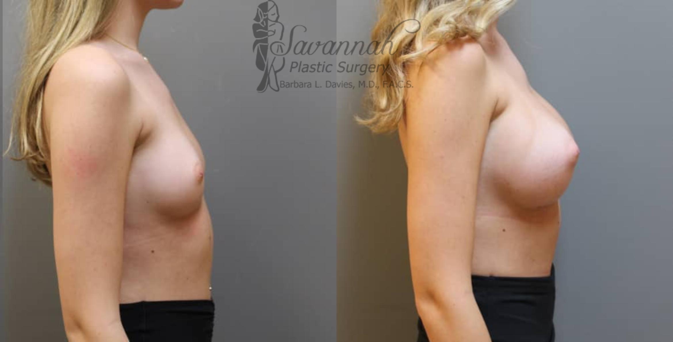 Before & After Breast Augmentation Case 2 View 3 View in Savannah, Georgia