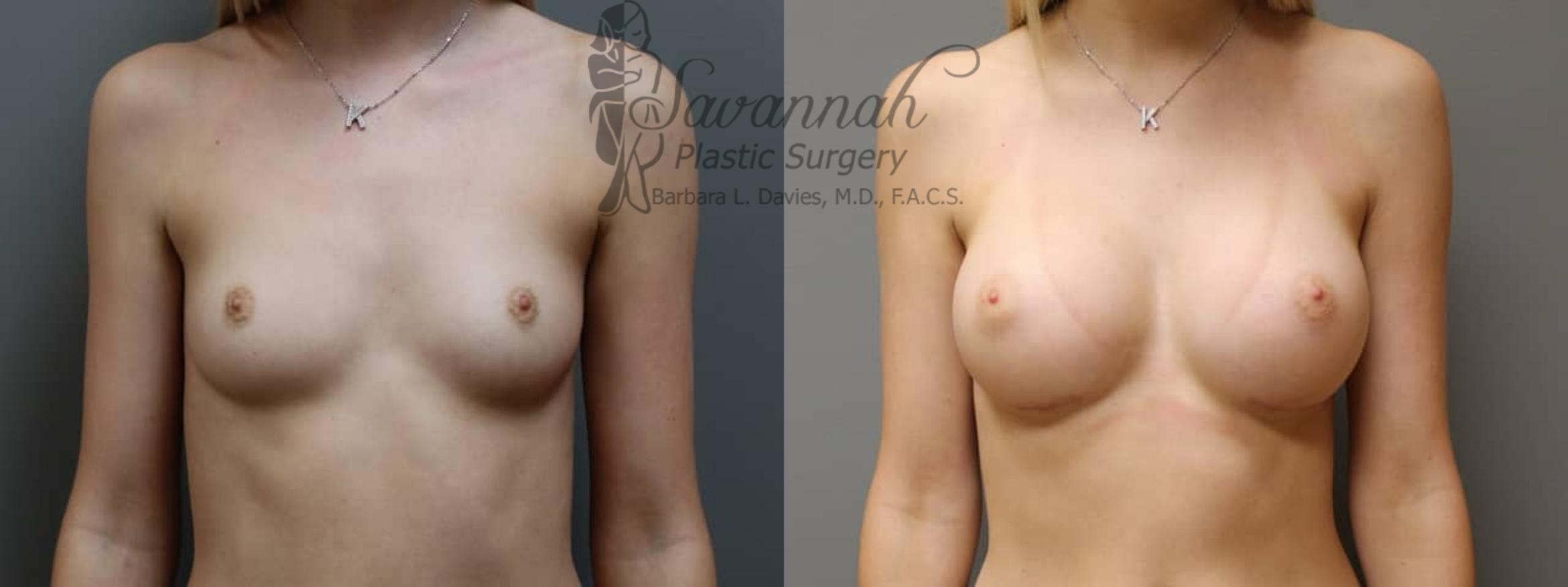 Before & After Breast Augmentation Case 3 View 1 View in Savannah, Georgia