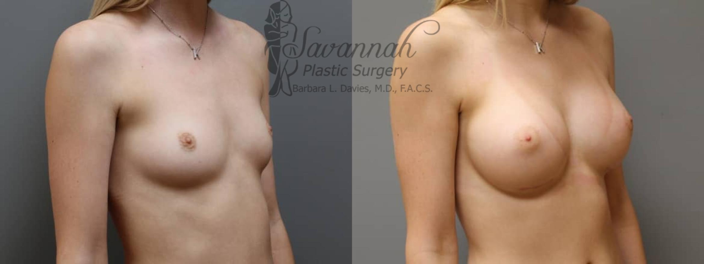 Before & After Breast Augmentation Case 3 View 2 View in Savannah, Georgia