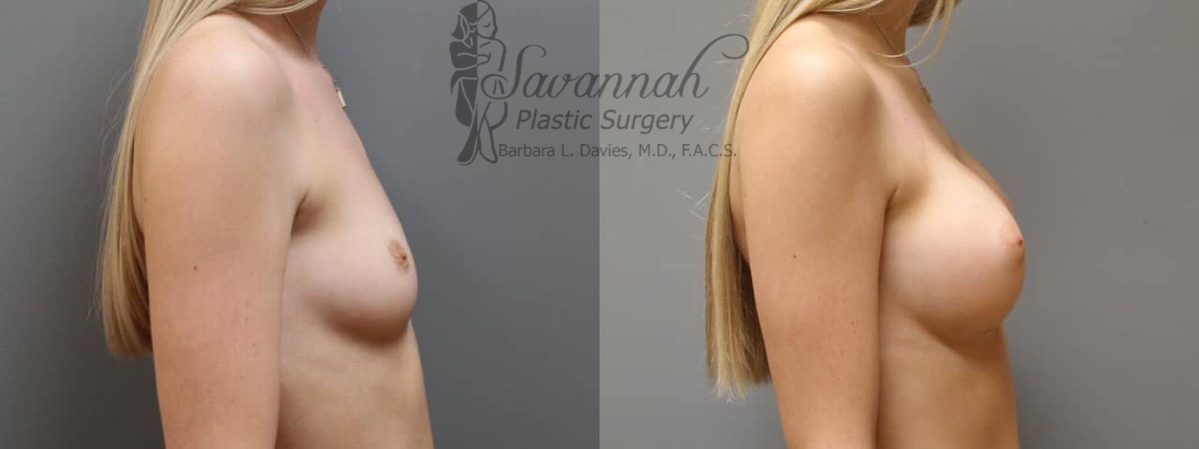 Before & After Breast Augmentation Case 3 View 3 View in Savannah, Georgia