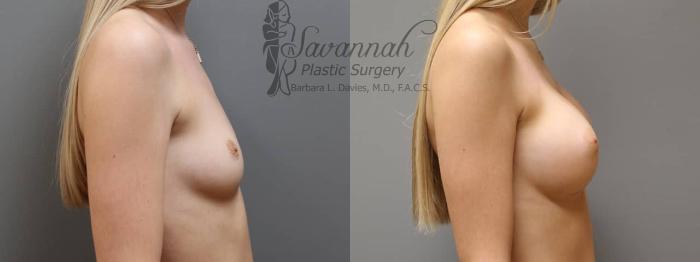 Before & After Breast Augmentation Case 3 View 3 View in Savannah, Georgia