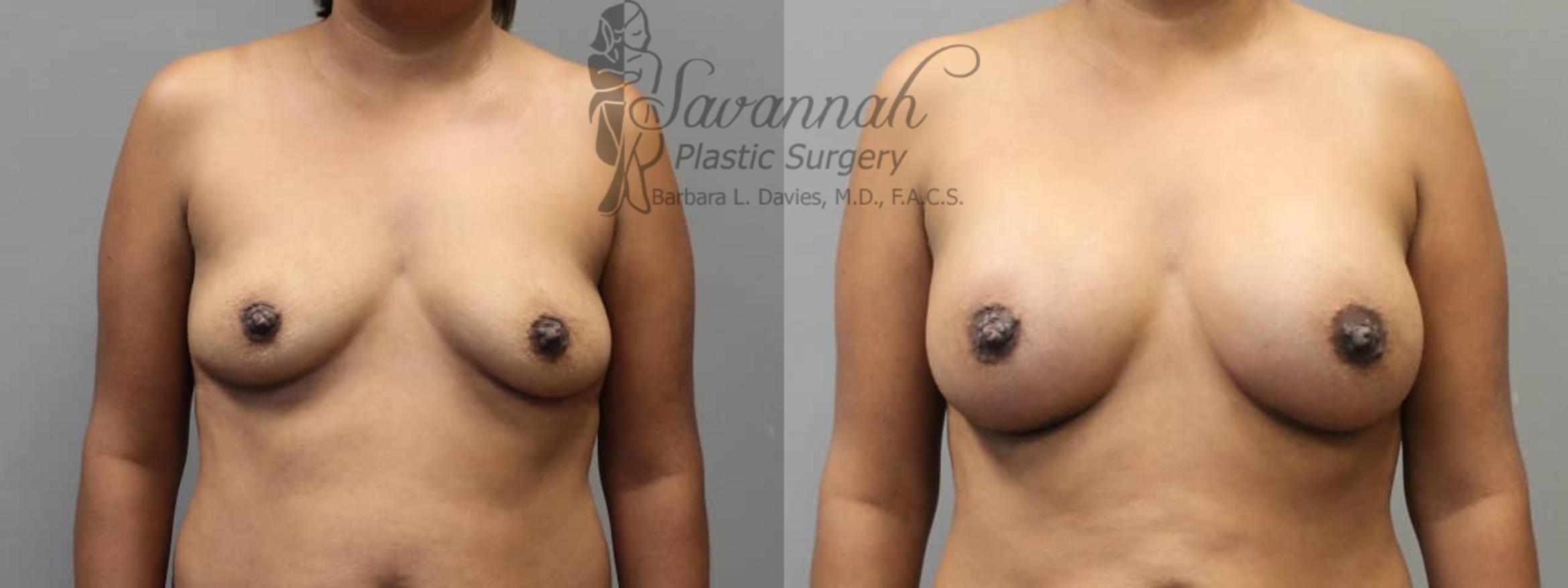 Before & After Breast Augmentation Case 4 View 1 View in Savannah, Georgia