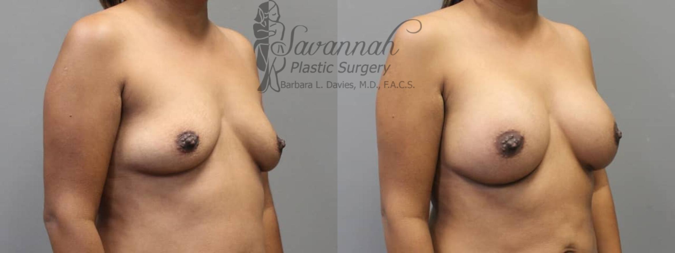 Before & After Breast Augmentation Case 4 View 2 View in Savannah, Georgia