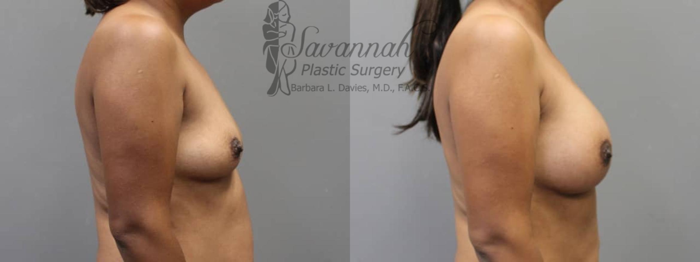 Before & After Breast Augmentation Case 4 View 3 View in Savannah, Georgia