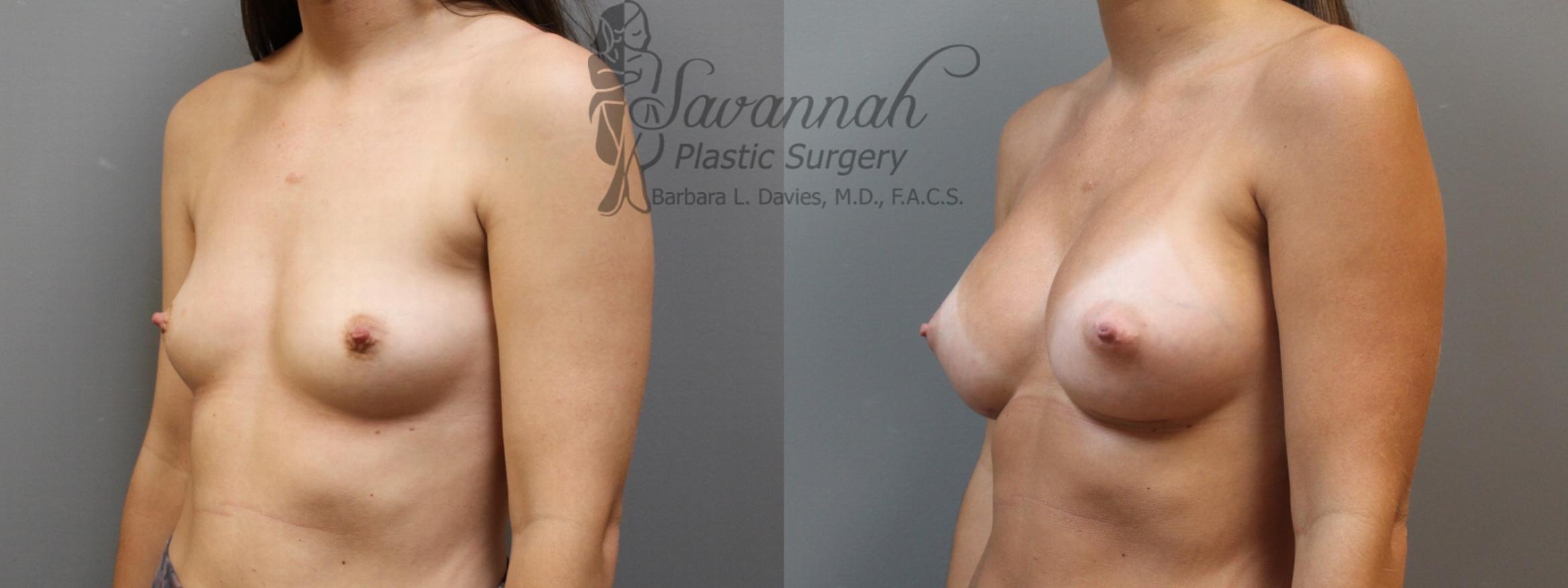 Before & After Breast Augmentation Case 5 View 2 View in Savannah, Georgia