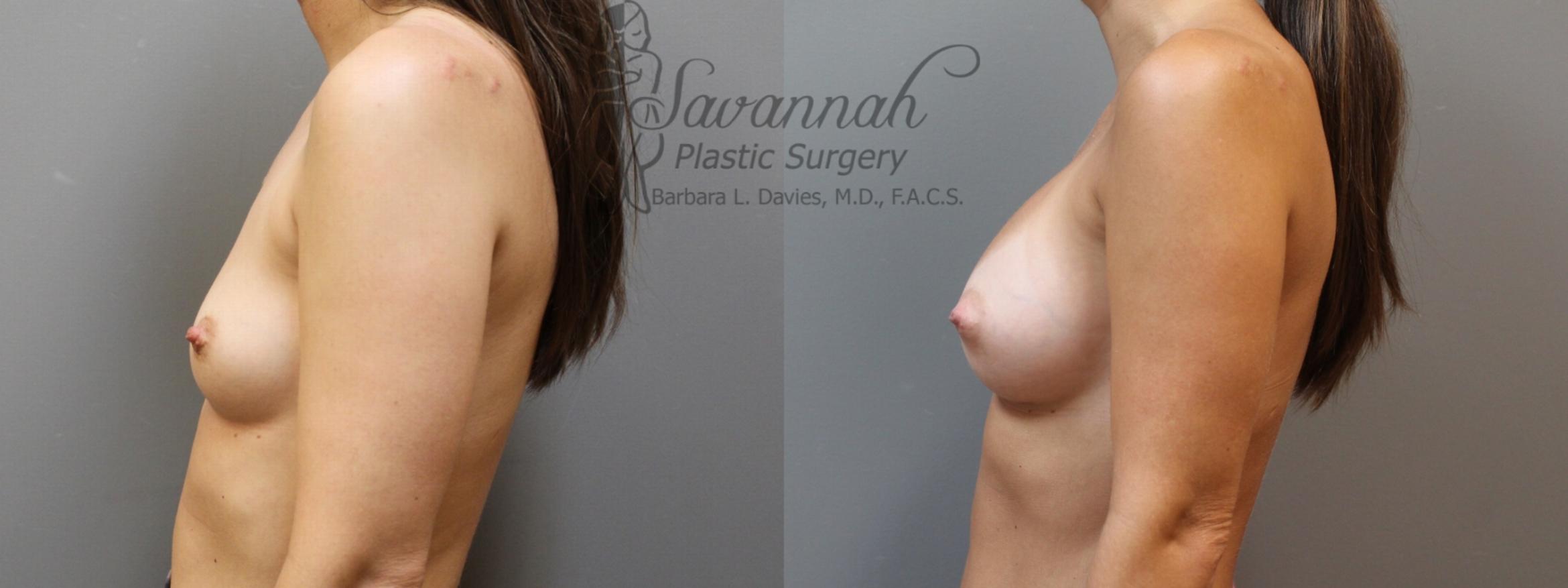 Before & After Breast Augmentation Case 5 View 3 View in Savannah, Georgia